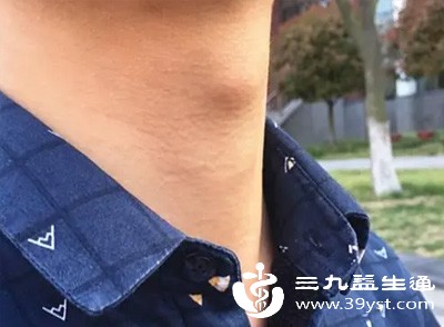 胃食管反流是常见诱因之一,胃酸反流至咽喉部,会刺激黏膜发炎、肿胀,出现嗓子发堵、有异物感 胃食管反流是常见诱因之一,胃酸反流至咽喉部,会刺激黏膜发炎、肿胀,出现嗓子发堵、有异物感