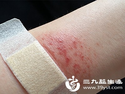揭开膏药贴后火辣辣的秘密 应对与预防方法全在这