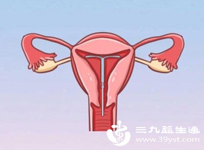 人工流产术后立即上环