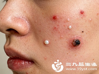 告别暗疮不用等 掌握这些快速去除法皮肤清爽看得见