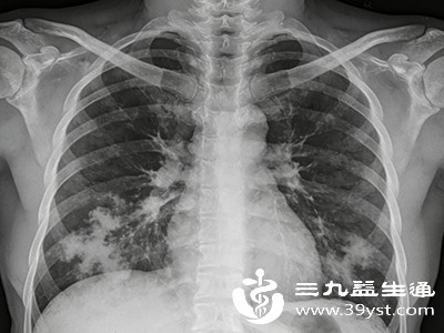 肺炎的早期症状及表现 及时识别是康复关键