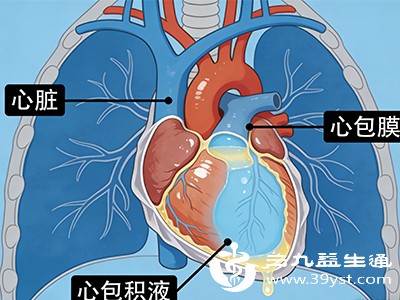心包积液是否危险 从病因到应对 看懂这些心中不慌
