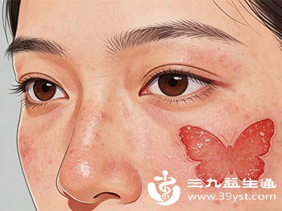 了解红斑狼疮早期症状 皮肤血液等方面的异常要警惕