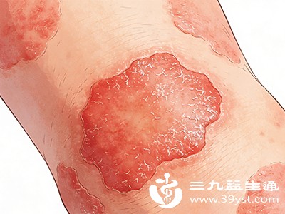 多累及手指、手腕、膝盖、脚踝等关节，表现为对称性的疼痛和肿胀，早晨起床时可能伴有僵硬感，活动后可有所缓解