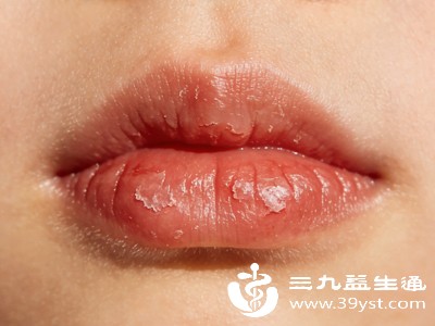 口角炎主要发生在嘴角两侧，表现为嘴角发红、开裂、疼痛，有时会伴随渗液、结痂，孩子说话、吃饭时疼痛会加重，还可能出现张口困难的情况