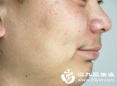 面神经炎是导致突发脸歪嘴歪的最常见原因，多由受凉、病毒感染等引发，发病较急，通常单侧发病