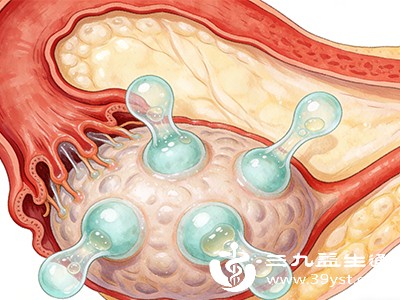 宫颈纳囊不神秘多因腺管堵塞 炎症 分娩损伤是常见诱因