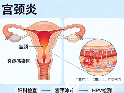 慢性宫颈炎病程长，反复刺激使腺管开口逐渐狭窄，堵塞难以恢复，长期累积形成多个纳囊，已婚女性发生率较高
