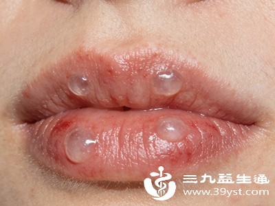 皮肤出现透明水泡别乱弄 先看是否属于这几类情况再处理