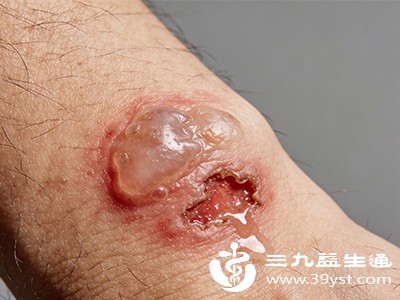 大疱性类天疱疮