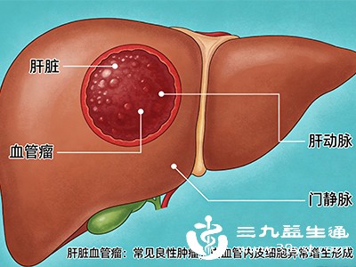 查出肝脏血管瘤别慌 严不严重看这几点 小的定期查 大的需干预