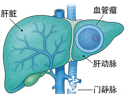 多数血管瘤生长缓慢，每年增长不超过1厘米，甚至长期稳定