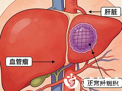 肝脏血管瘤是良性病变，目前尚无癌变的案例报道，无需担心恶变风险，避免因过度恐惧盲目治疗