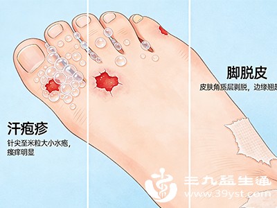 手部和足部皮疹