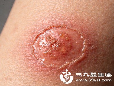 局部感染表现为针孔周围红肿、灼热、疼痛，可伴有脓性分泌物