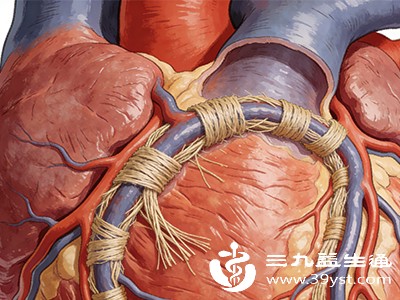 心肌桥 一种先天性冠脉异常 可能引发胸痛了解它很重要