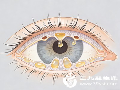 晨起眼干有分泌物 警惕睑板腺堵塞 自愈可能性及护理法在此