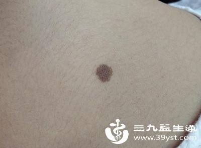 人体的激素水平犹如身体的“指挥棒”，对痣的形成有着重要影响