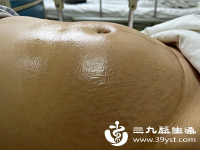 右心负责将血液泵入肺部进行氧合，当右心衰竭时，体循环瘀血，静脉压力升高，腹腔内静脉血液回流受阻，液体容易在腹腔积聚形成腹水