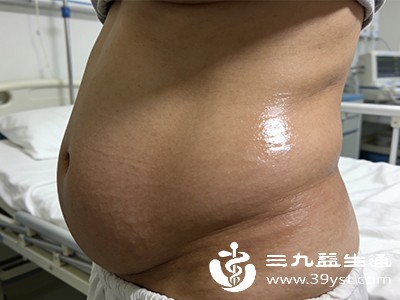 结核分枝杆菌感染腹膜后，会引起腹膜充血、水肿、渗出，导致腹水产生