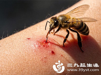 被蜜蜂蛰了痒得钻心 毒刺别乱拔 教你正确处理轻松应对不遭罪