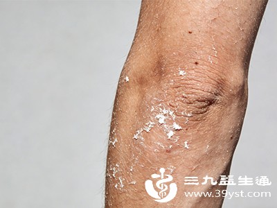 甲状腺功能减退、糖尿病等疾病可能导致皮肤干燥，若调整生活方式后症状仍未改善，需及时就医检查，明确病因后对症治疗