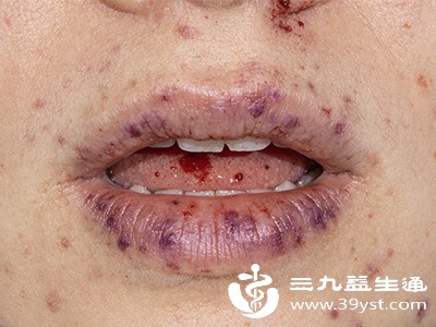 长期接触超标甲醛，会增加鼻咽癌、白血病等癌症的发病风险，儿童是白血病的高危人群