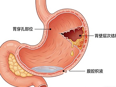 胃穿孔绝非小事 了解其严重性 诱因与紧急应对办法