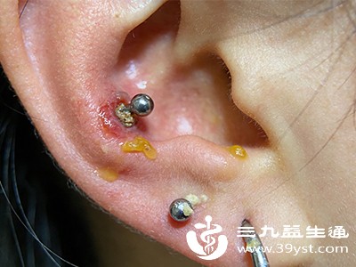 暂时不要佩戴耳饰，待流脓症状完全消失、耳洞愈合后再佩戴