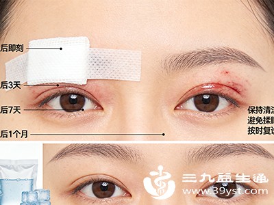 双眼皮5天与7天拆线的区别 从愈合到恢复的细节差异