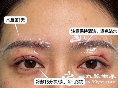 5天拆线可能让早期肿胀消退更快