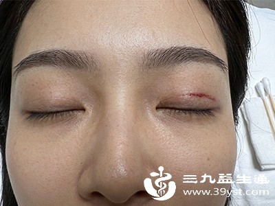 更适合创伤较大的全切双眼皮手术