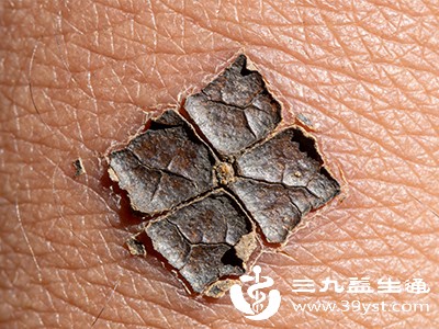 鱼鳞病危害不小 伤皮肤 扰心理 降生活质量 这些影响要知晓