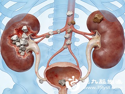 肾结石碎石后疼痛不是“白做了” 这些情况要警惕 处理方法看这里