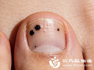 脚趾甲有黑点是怎么回事 从良性瘀血到恶性病变 成因与应对全指南