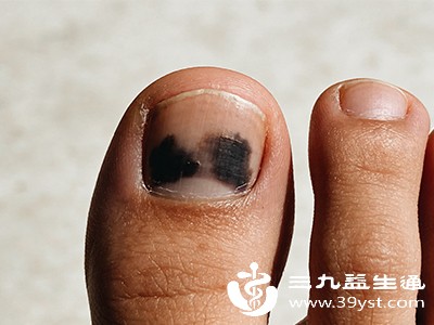 多由皮肤癣菌感染引起，通过接触传播，足部潮湿多汗、鞋袜不透气、免疫力低下者易患病