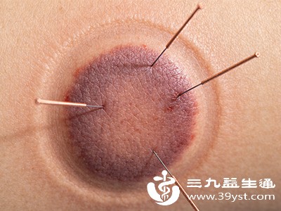 针灸治疗可选取曲池、合谷、阴陵泉等穴位，通过针刺调节气血，清热祛湿