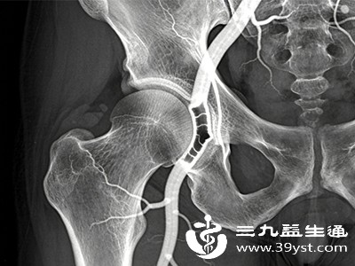 下肢血管狭窄或硬化