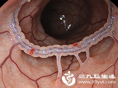 胃出血 不可轻视的消化道急症