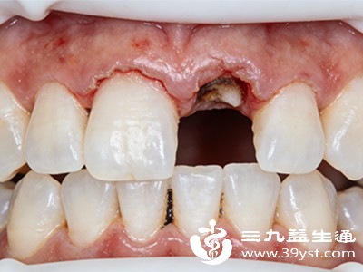 牙龈萎缩想恢复 轻度有希望 中重度做好这些能稳住