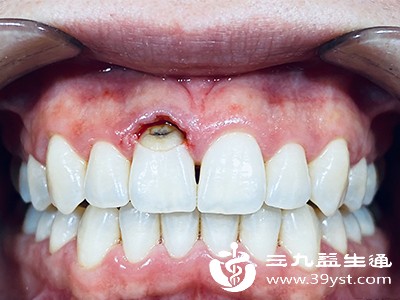牙齿排列与咬合问题 牙齿排列与咬合问题