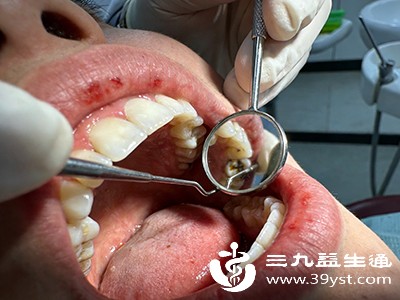 每6-12个月洗牙一次，及时发现并治疗牙龈炎、牙周炎，阻止病情发展