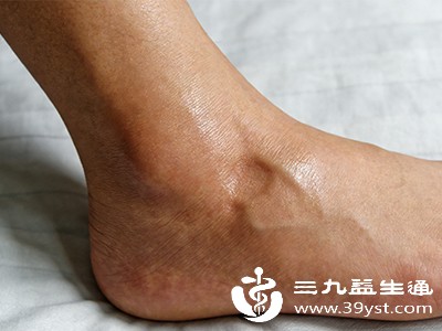 脚肿不消要警惕 教你快速缓解 出现这些症状赶紧去看医生