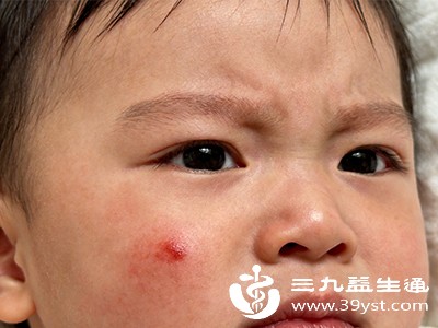宝宝脸起蚊子红包别慌 正确处理步骤全解析 消包快还不伤皮肤