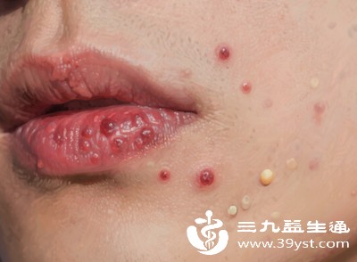 面部出油与痤疮爆发