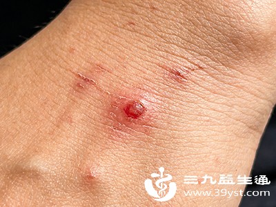 瘙痒与消退特点