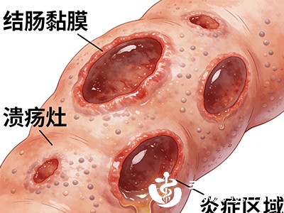 慢性肠炎、溃疡性结肠炎等患者,肠道黏膜有损伤,纤维和籽会刺激受损部位,加重炎症和腹泻 慢性肠炎、溃疡性结肠炎等患者,肠道黏膜有损伤,纤维和籽会刺激受损部位,加重炎症和腹泻