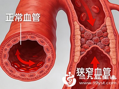 下肢血管硬化 下肢血管硬化