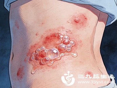 发烧伴随皮肤破损(如水痘、带状疱疹),洗澡可能导致感染扩散,需避开破损部位或遵医嘱 发烧伴随皮肤破损(如水痘、带状疱疹),洗澡可能导致感染扩散,需避开破损部位或遵医嘱