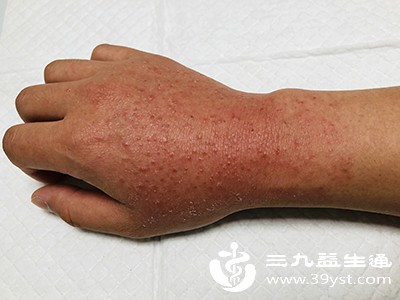 食用易过敏水果后，可能出现口腔瘙痒、皮疹、腹泻等症状，加重经期身体的不适感